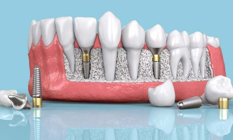 ایمپلنت دندان زایگما