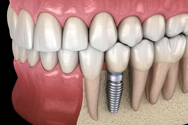 ایمپلنت دندان زایگما چیست؟ فیکسچر های آن چیست؟