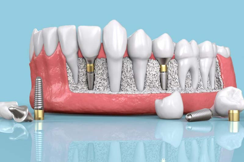ایمپلنت دندان زایگما