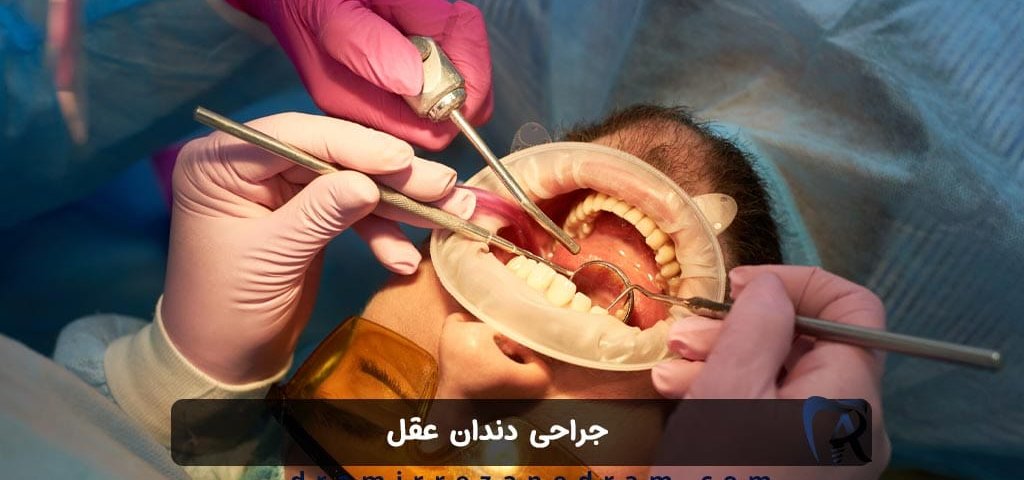 جراحی دندان عقل در ستارخان تهران