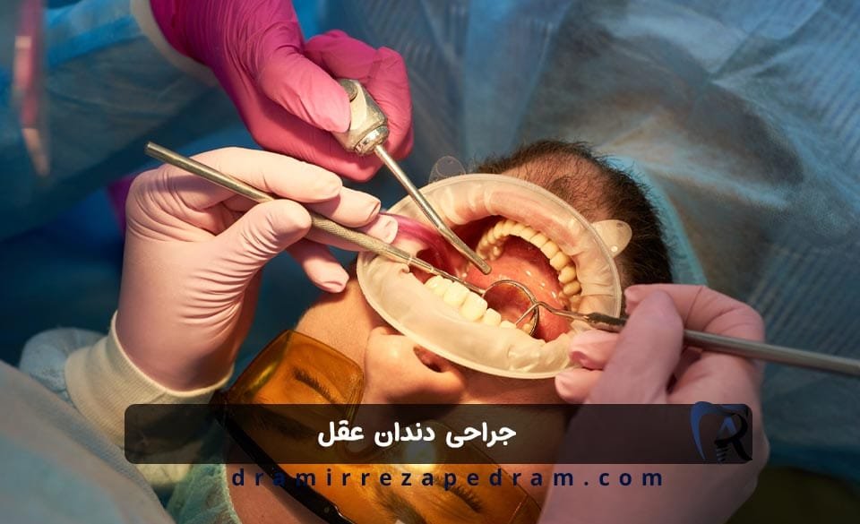 جراحی دندان عقل در ستارخان تهران