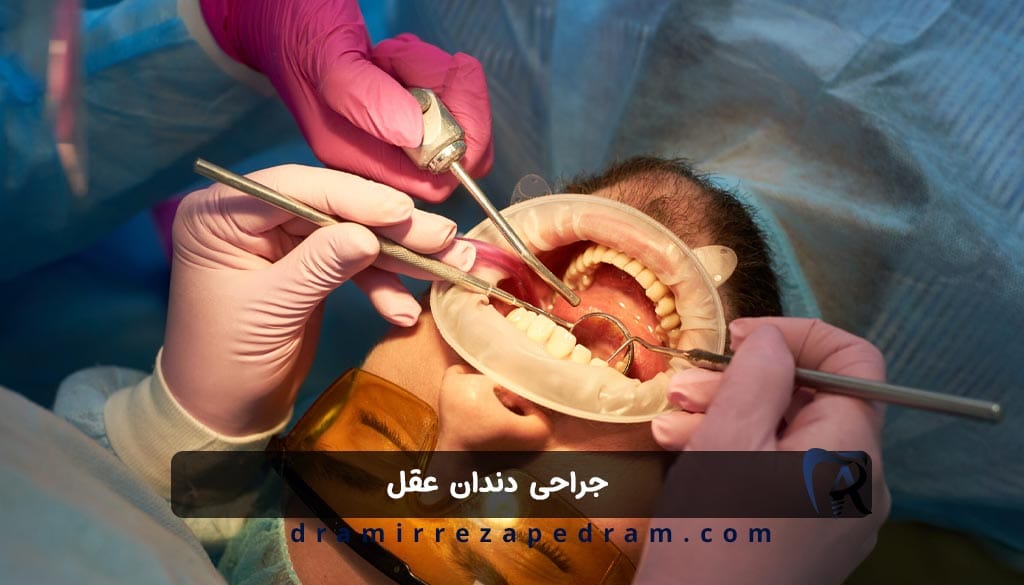 جراحی دندان عقل در ستارخان تهران