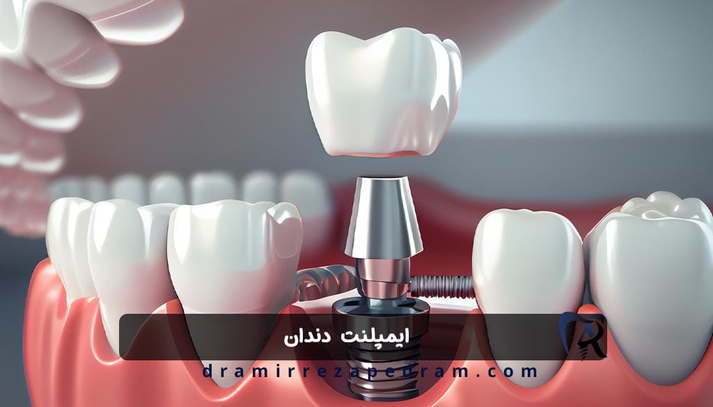 ایمپلنت دندان در ستارخان تهران