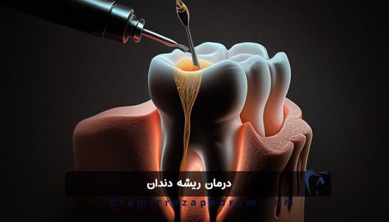 درمان ریشه دندان در ستارخان تهران