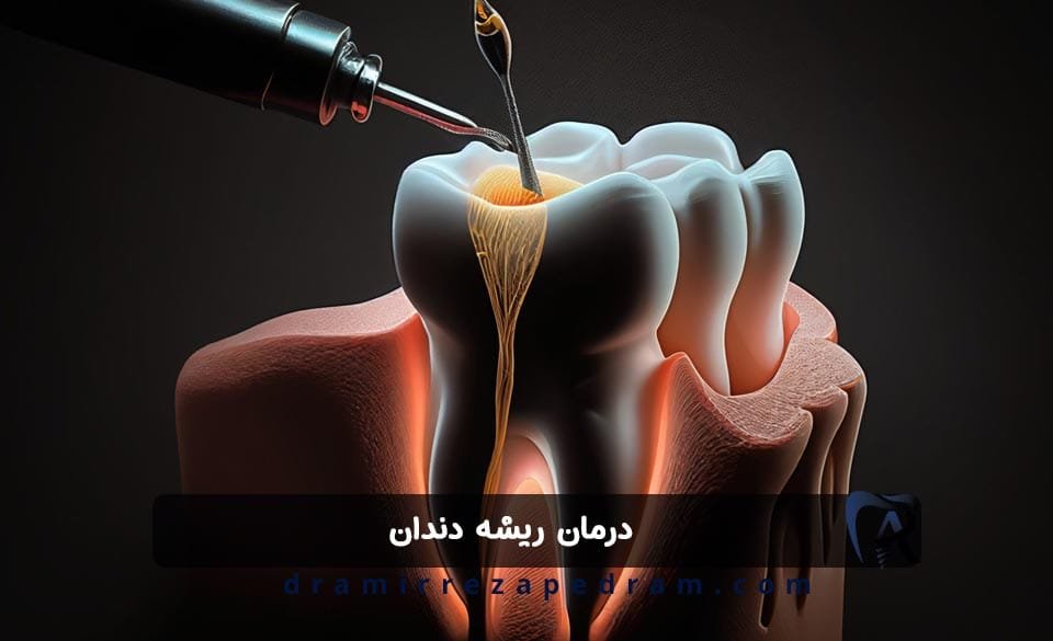 درمان ریشه دندان در ستارخان تهران