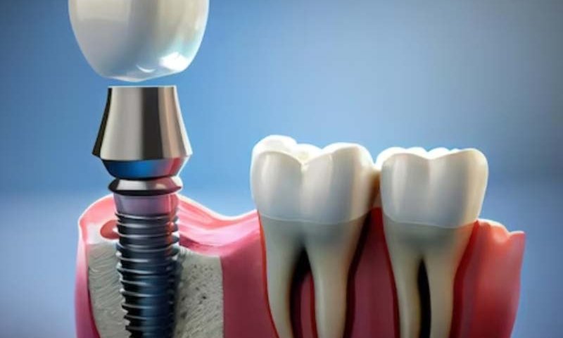 ایمپلنت زیمر ZIMMER