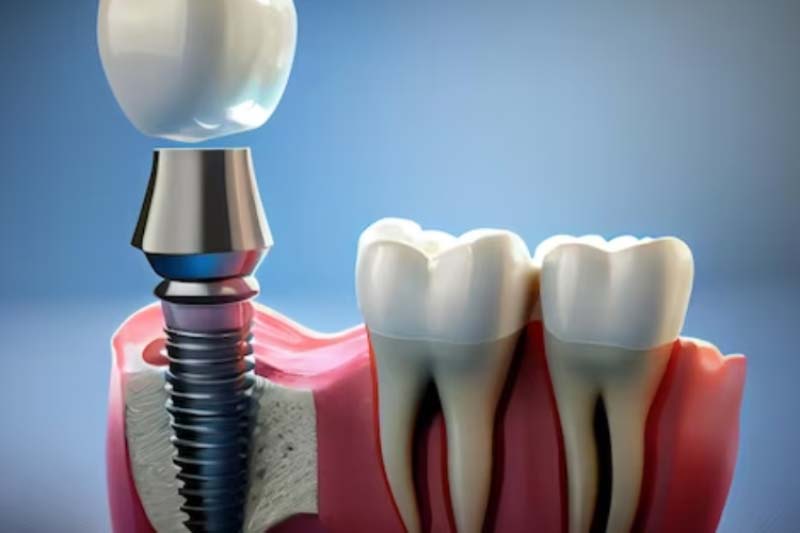 ایمپلنت زیمر ZIMMER