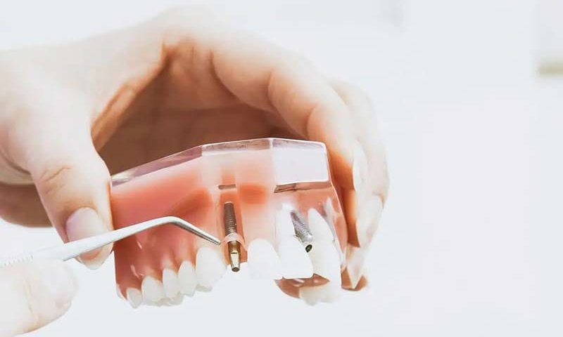 ایمپلنت سیمفونی