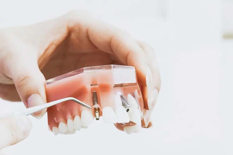 ایمپلنت سیمفونی