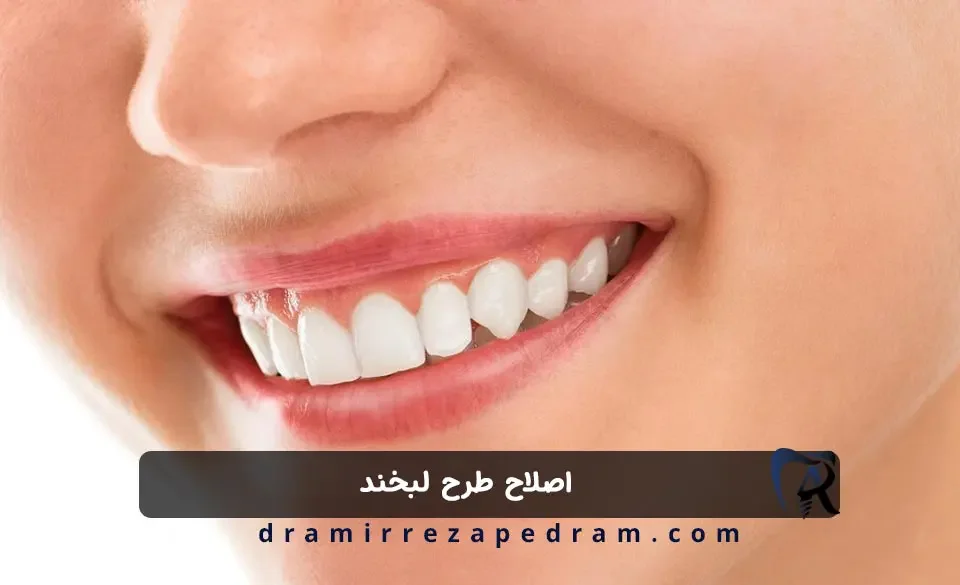 اصلاح طرح لبخند در مرزداران