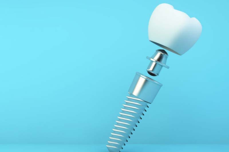 چه عواملی بر تعیین هزینه نهایی ایمپلنت دندان اینترالاک تاثیر گذار است؟