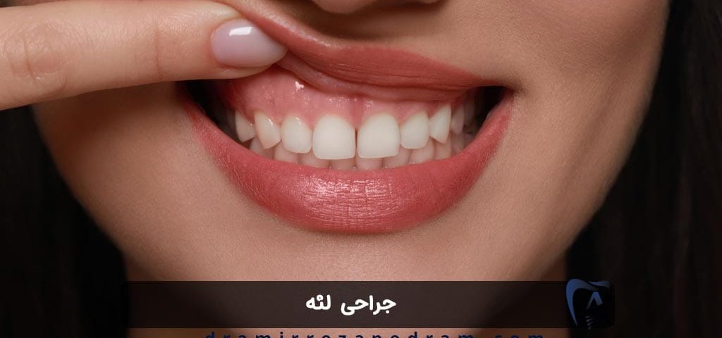 جراحی لثه در ستارخان تهران