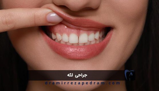 جراحی لثه در ستارخان تهران