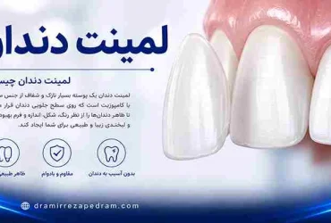 لمینت دندان چیست؟