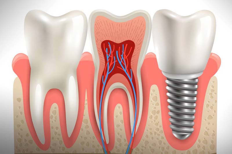 مزایا و معایب ایمپلنت بایوتم کره چیست؟