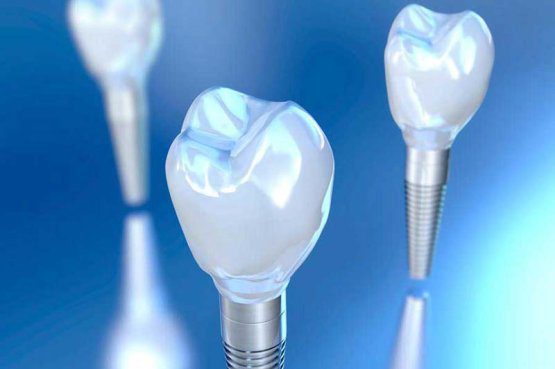 در مقایسه با برند های دیگر هزینه ایمپلنت دندان دنتیس وان کیو به چه صورتی است؟