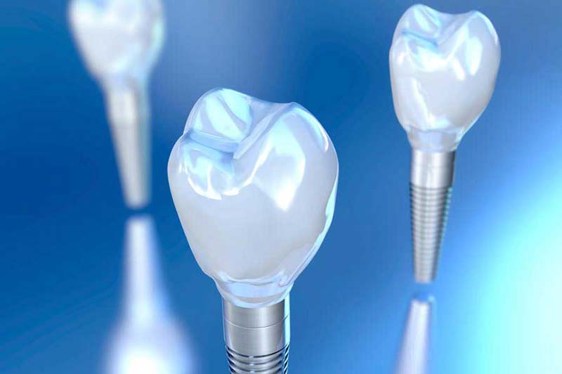 در مقایسه با برند های دیگر هزینه ایمپلنت دندان دنتیس وان کیو به چه صورتی است؟