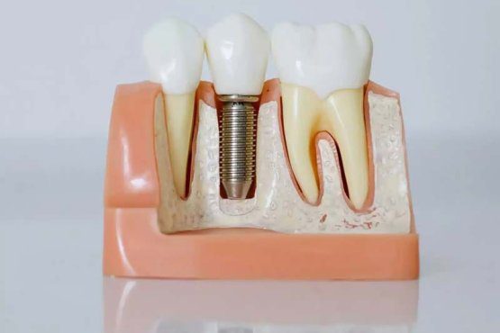 ایمپلنت نئودنت (Neodent) چیست؟