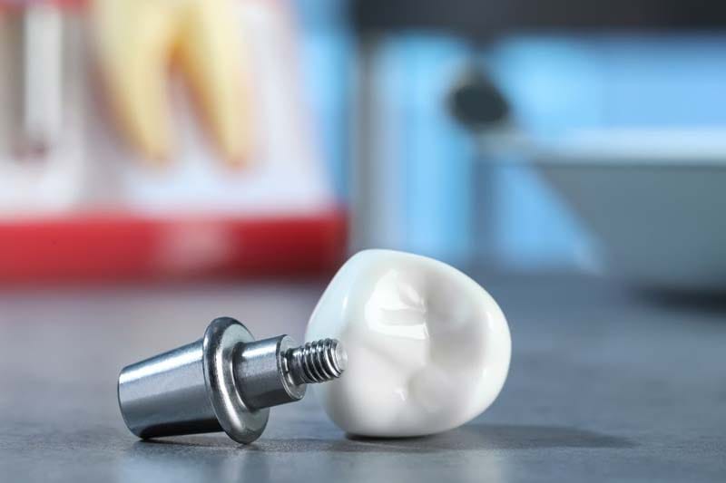 فرایند نصب ایمپلنت سیمفونی شامل چند مرحله است؟