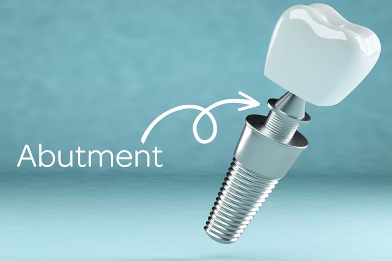 توصیه ها و مراحلی که قبل و بعد از کاشت ایمپلنت اینترالاک نیاز است چیست؟