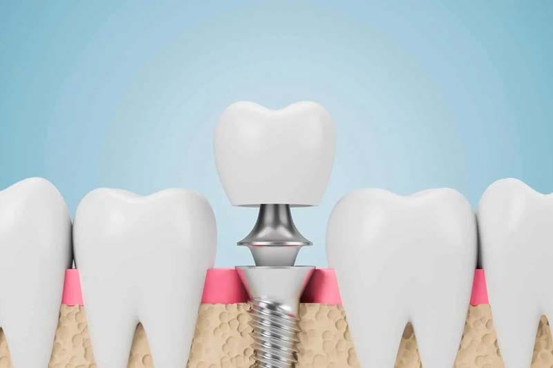 ویژگی های ایمپلنت سیمفونی