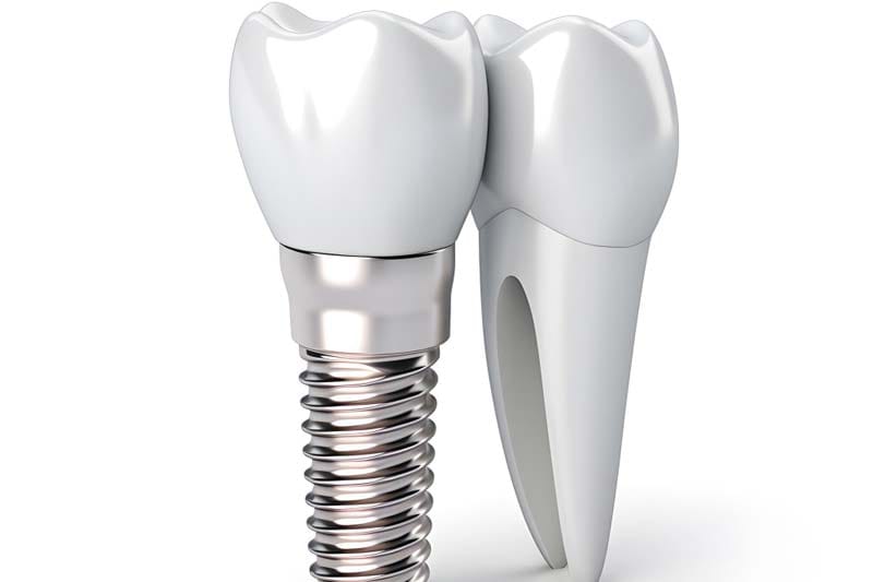 ایمپلنت و فیکسچر های دنتیس وان کیو چیست؟