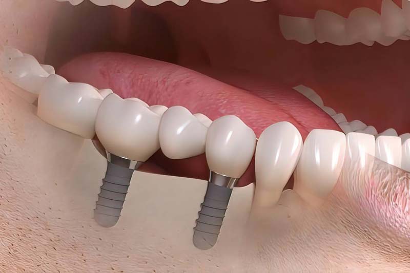 هزینه و مراحل انجام ایمپلنت کره ای ایمپلنتیوم چیست؟