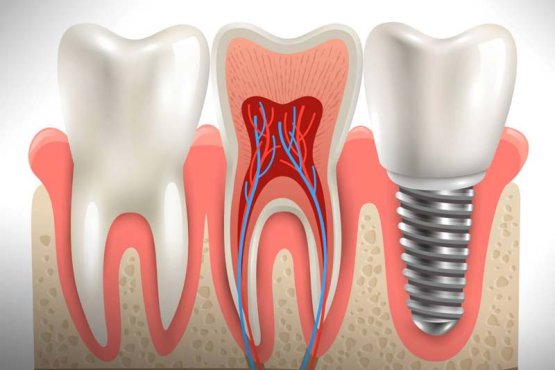 مزایا و معایب ایمپلنت بایوتم کره چیست؟