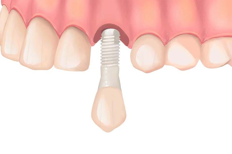 مزایا و معایب ایمپلنت دندان زایگما چیست؟