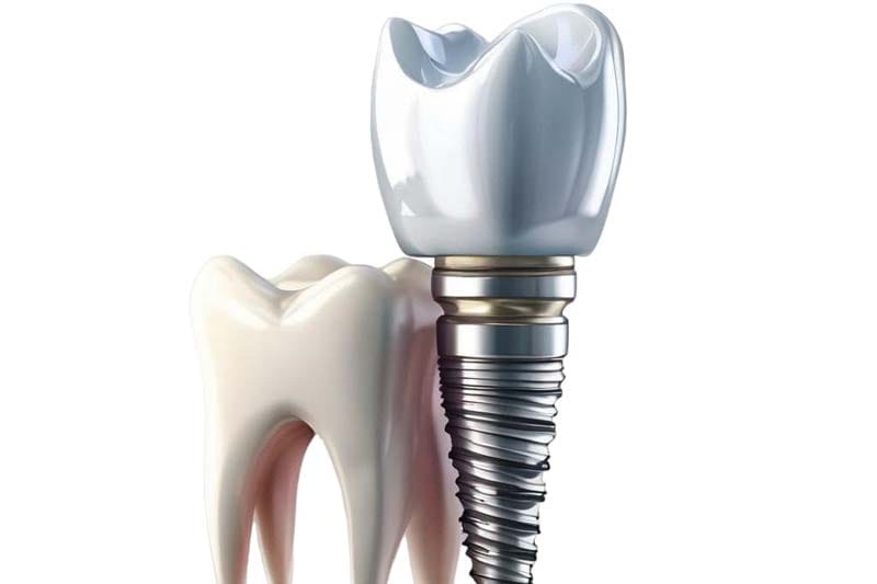 مزایا و معایب ایمپلنت دندان اس پی ای چیست؟