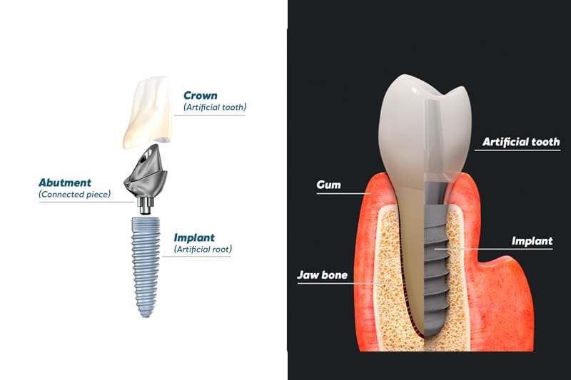 مراحل کاشت ایمپلنت بایوتم کره ای چیست؟