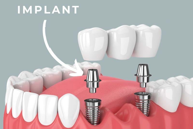 مراحل کاشت ایمپلنت دیو چیست؟