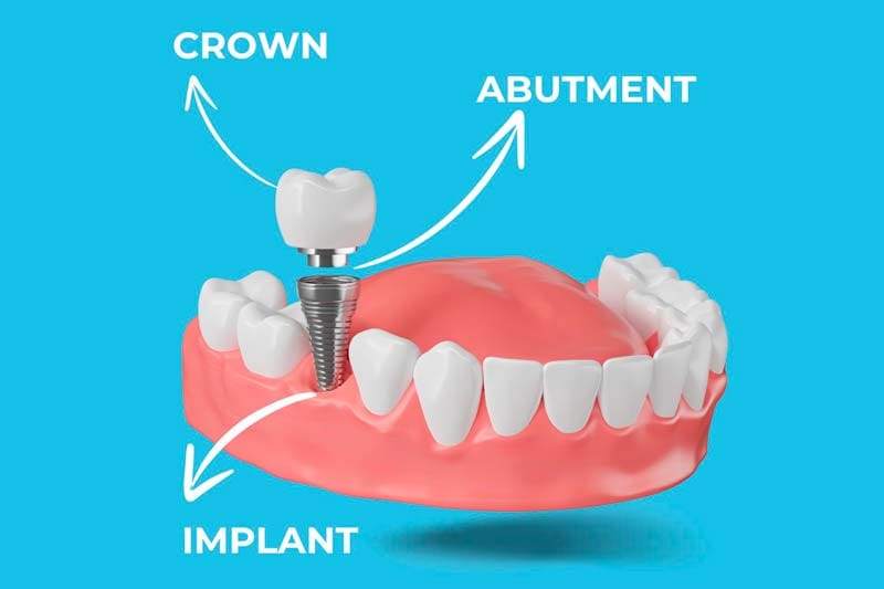 مراحل کاشت ایمپلنت نئودنت چیست؟