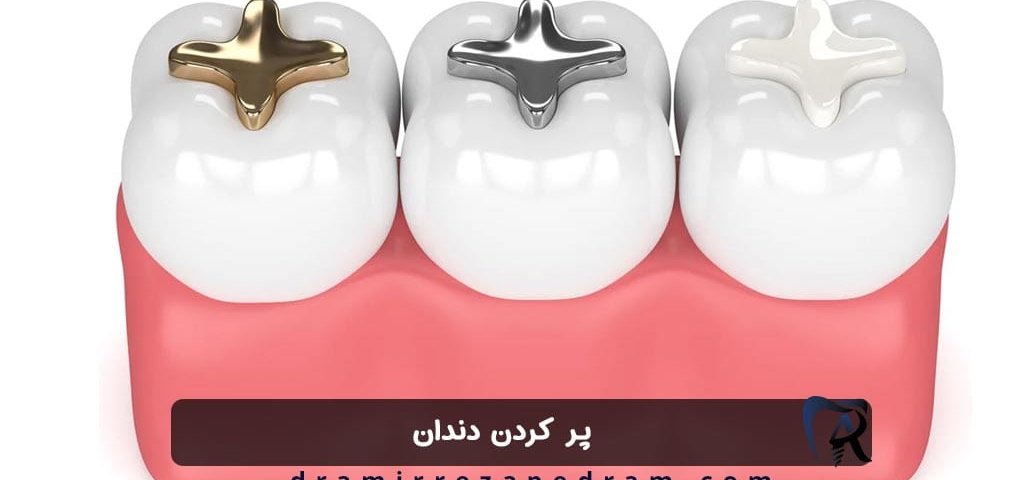 پر کردن دندان در ستارخان تهران
