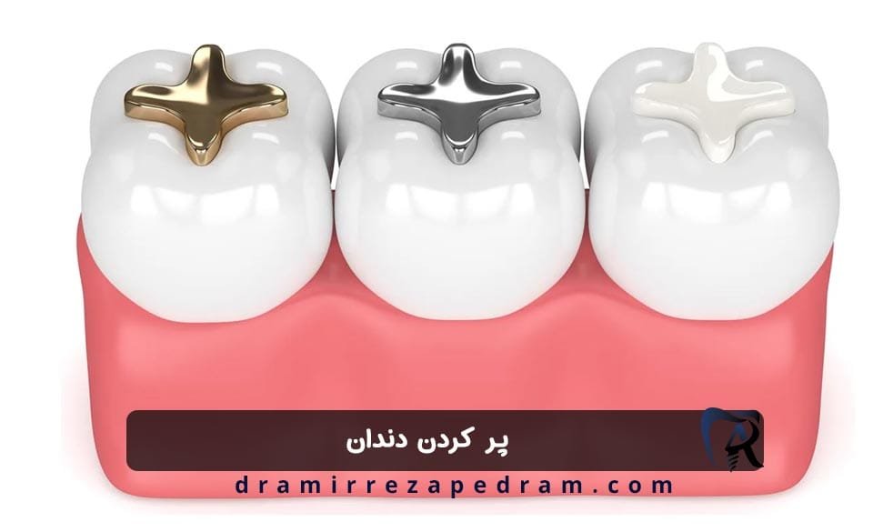 پر کردن دندان در ستارخان تهران