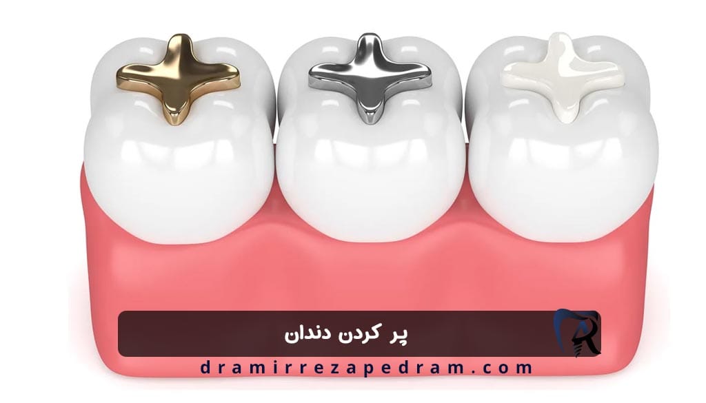 پر کردن دندان در ستارخان تهران