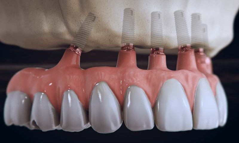 ایمپلنت کره ای ایمپلنتیوم