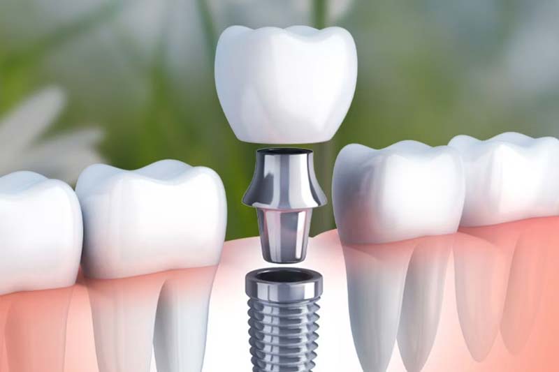 ایمپلنت کره ای ایمپلنتیوم چیست