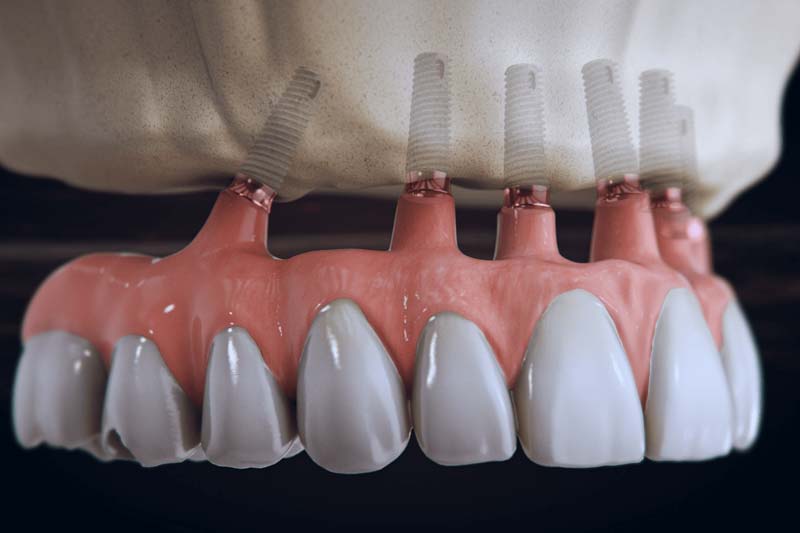 ایمپلنت کره ای ایمپلنتیوم