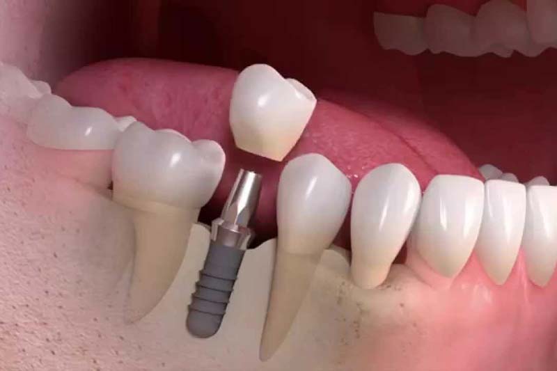 ایمپلنت کره ای بایوتم چیست؟