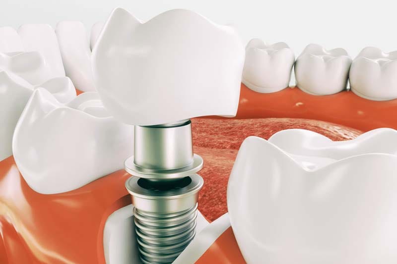 ایمپلنت کره ای دنتیس وان کیو