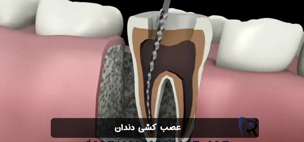 عصب کشی دندان در ستارخان تهران