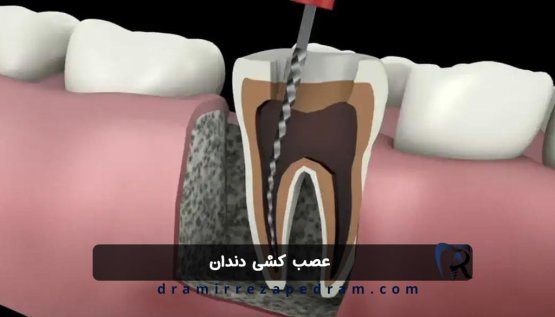 عصب کشی دندان در ستارخان تهران