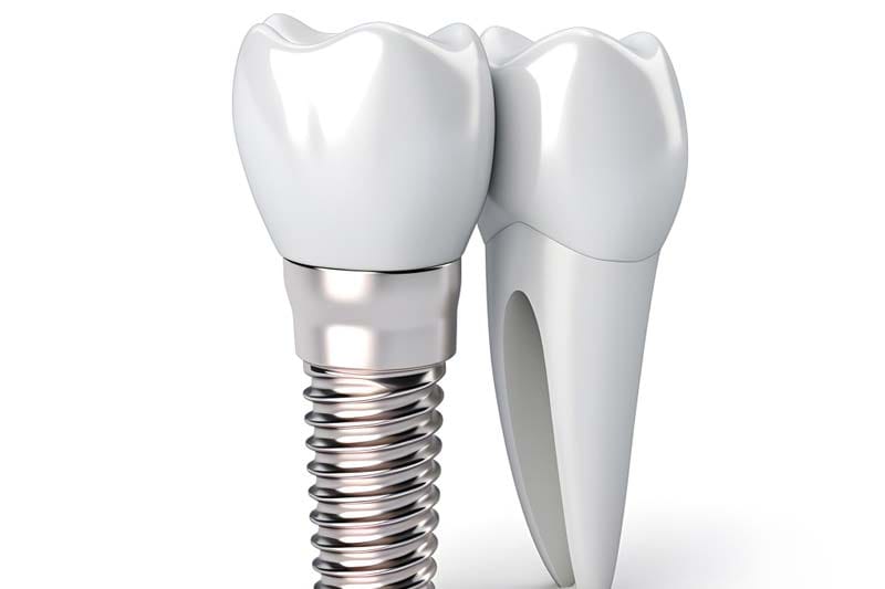 ایمپلنت BEGO آلمانی و فیکسچرهای آن