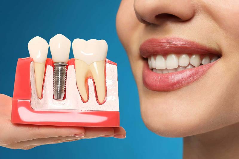 ایمپلنت SIC سوئیسی و فیکسچر های آن