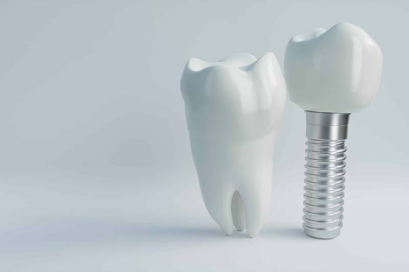 ایمپلنت آلمانی زایو xive چیست؟