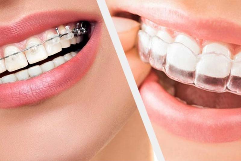 انجام ارتودنسی زیبایی در غرب تهران