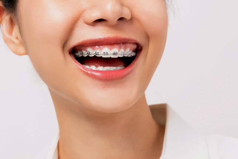 بعد از ارتودنسی در غرب تهران به چه مراقبت هایی نیاز داریم؟