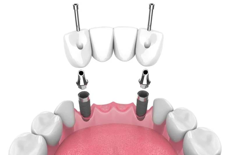 بعد از انجام ایمپلنت آلفادنت چه مراقبت هایی نیاز است؟
