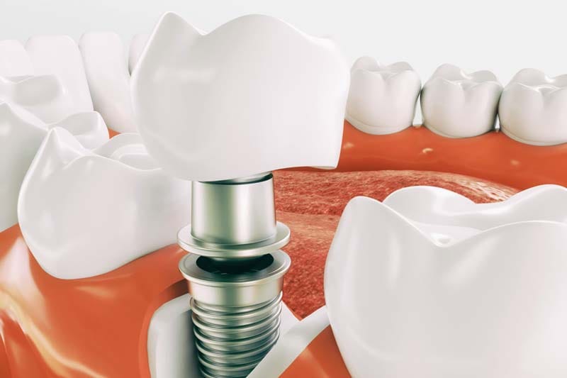 مراحل انجام ایمپلنت سوئیسی ای تی ای چیست؟